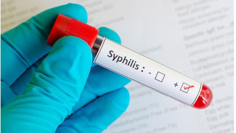 Preocupa el avance de los contagios de Sífilis en San Juan: ya superó la media de VIH