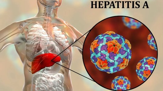 Argentina regitra un brote de hepatitis A: ya reportaron 69 casos en 13 distritos