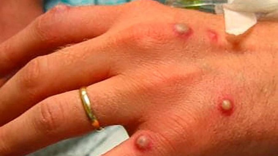 Viruela del mono: cuatro nuevos casos, uno corresponde a San Juan